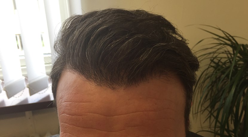 hårtransplantation efter operation